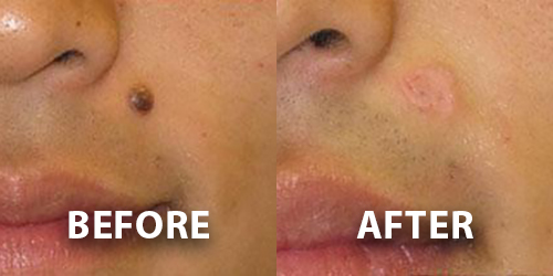 Mole Removal Dermatology