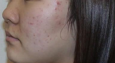 Acne Scar Removal Before & After Patient #63