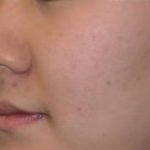 Acne Scar Removal Before & After Patient #63