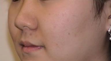 Acne Scar Removal Before & After Patient #63