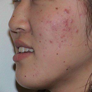 Acne Scar Removal Before & After Patient #66