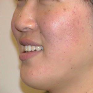 Acne Scar Removal Before & After Patient #66
