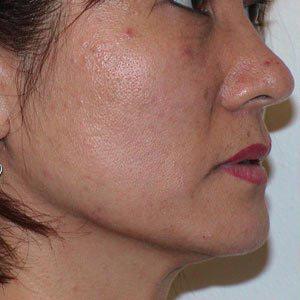 Before & After Patient #72