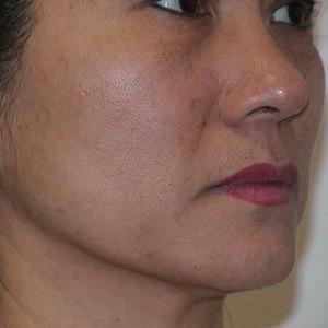 Before & After Patient #72