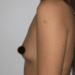 Breast Augmentation Before & After Patient #196