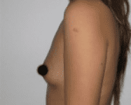 Breast Augmentation Before & After Patient #196