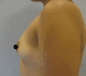 Breast Augmentation Before & After Patient #195