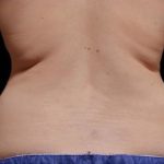 CoolSculpting Before & After Patient #262