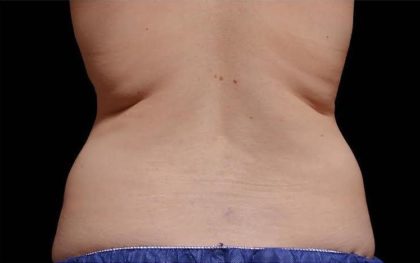 CoolSculpting Before & After Patient #262