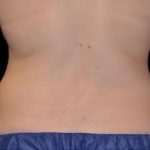 CoolSculpting Before & After Patient #262
