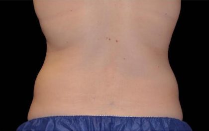 CoolSculpting Before & After Patient #262