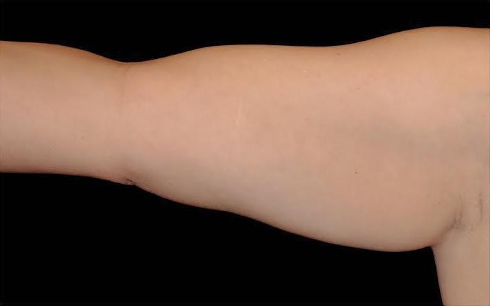 CoolSculpting Before & After Patient #285