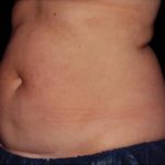 CoolSculpting Before & After Patient #286