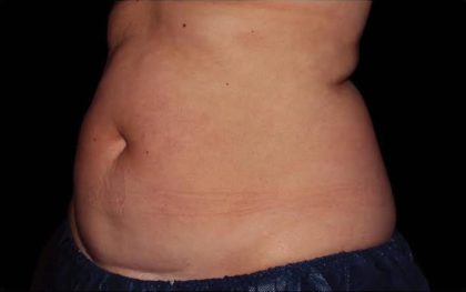 CoolSculpting Before & After Patient #286