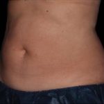 CoolSculpting Before & After Patient #286