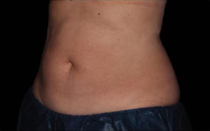 CoolSculpting Before & After Patient #286