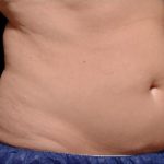 CoolSculpting Before & After Patient #269