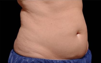 CoolSculpting Before & After Patient #269