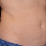 CoolSculpting Before & After Patient #269