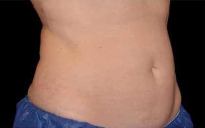CoolSculpting Before & After Patient #269