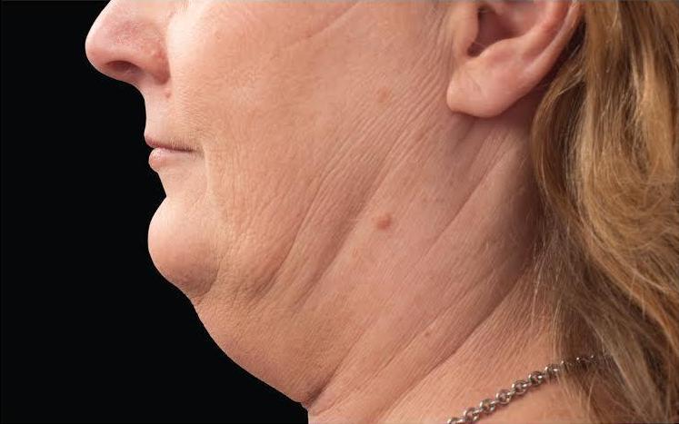 CoolSculpting Before & After Patient #272