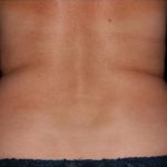 CoolSculpting Before & After Patient #273