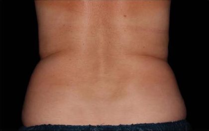 CoolSculpting Before & After Patient #273