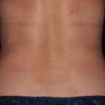 CoolSculpting Before & After Patient #273