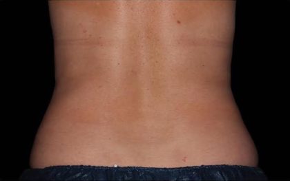 CoolSculpting Before & After Patient #273