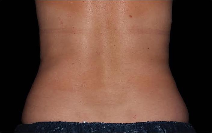 CoolSculpting Before & After Patient #273
