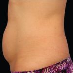 CoolSculpting Before & After Patient #282