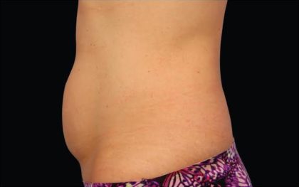 CoolSculpting Before & After Patient #282