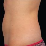 CoolSculpting Before & After Patient #282