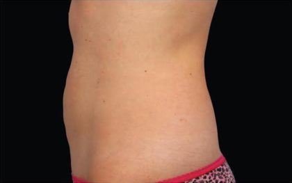 CoolSculpting Before & After Patient #282