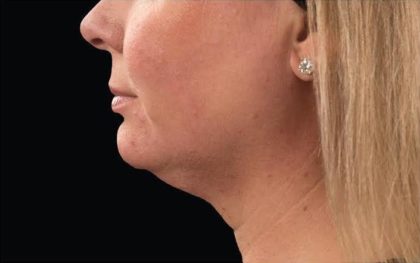 CoolSculpting Before & After Patient #287