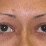 Eye Lift Before & After Patient #215