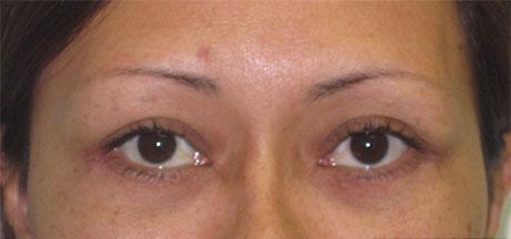 Eye Lift Before & After Patient #215