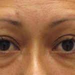 Eye Lift Before & After Patient #215