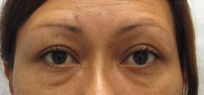 Eye Lift Before & After Patient #215