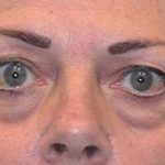 Eye Lift Before & After Patient #219