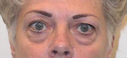 Eye Lift Before & After Patient #219