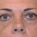 Eye Lift Before & After Patient #219