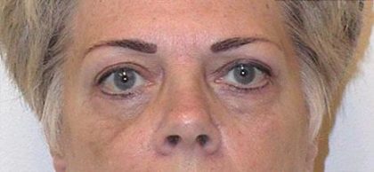 Eye Lift Before & After Patient #219