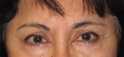 Eye Lift Before & After Patient #225