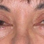 Eye Lift Before & After Patient #225