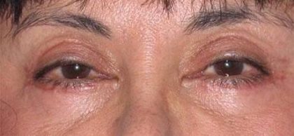 Eye Lift Before & After Patient #225