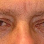 Eye Lift Before & After Patient #229