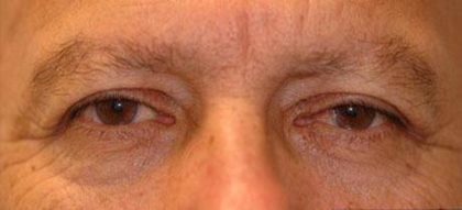 Eye Lift Before & After Patient #229