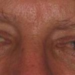 Eye Lift Before & After Patient #229