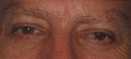 Eye Lift Before & After Patient #229